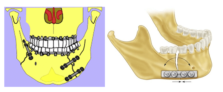 MAXILLOFACIAL-SURGERY-AKRUTHI