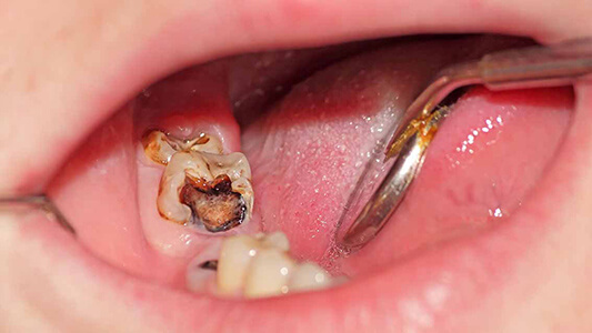 TEETH-EXTRACTIONS