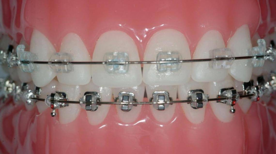 ceramic-braces-vs-metal-braces-akruthi-dental