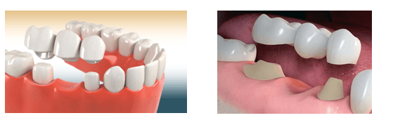 dental-crowns