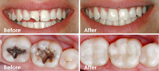 dental-fillings