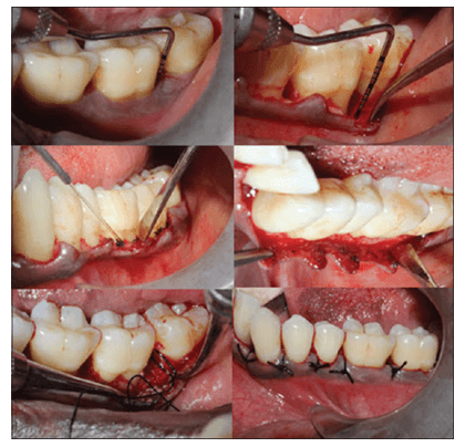 flap-surgery