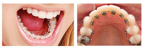 lingual-braces