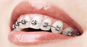 metal-braces-akruthi-dental-care
