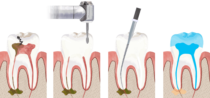 root-canal-treatment-in-mallapur